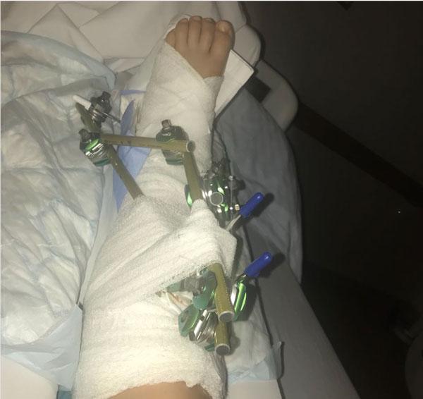 Анастасия Романова получила серьезную травму во время тренировки на горных лыжах 3